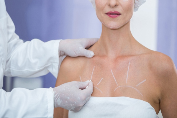 Doctor realizando el boceto para el aumento de pechos en una mujer, lo cual sirve de guía para realizar la cirugía
