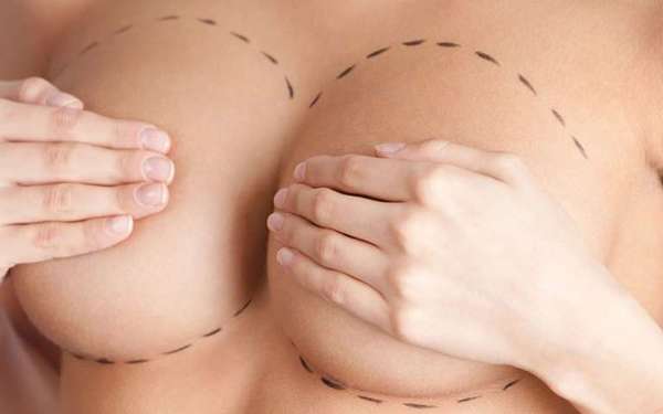 Reducción de senos en Turquía - Mujer con un boceto en los pechos, los cuales sirven de guía para realizar la cirugía de reducción de mamas
