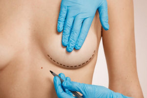 Clínicas de estética - imagen del pecho de una mujer donde el cirujano plástico esta dibujando en la piel los pasos de una mamoplastia