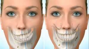 imagen del antes y después de una cirugía maxilofacial para corregir la mandíbula inferior torcida