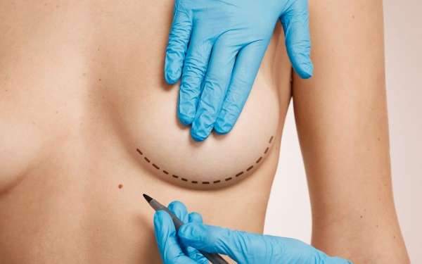 clínicas de aumento de pecho en Bilbao - Mujer en la consulta del cirujano plástico, el cual esta marcando la zona de corte para colocar el implante mamario