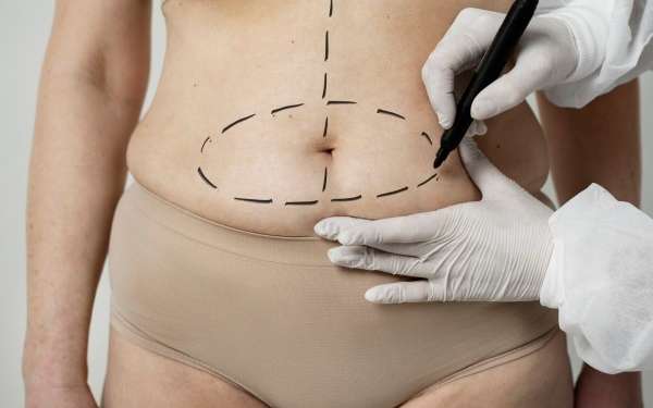 Clínicas de abdominoplastia en Murcia - imagen del vientre de una mujer la cual esta en la consulta del cirujano plástico el cual esta realizando el diseño de la cirugía de abdominoplastia