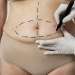 Clínicas de abdominoplastia en Murcia - imagen del vientre de una mujer la cual esta en la consulta del cirujano plástico el cual esta realizando el diseño de la cirugía de abdominoplastia