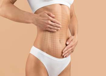 abdominoplastia en Barcelona - Abdominoplastia recortada de cuerpo femenino con abdomen plano y malla dibujada