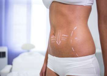 Abdominoplastia en Valencia - Mujer con el boceto de la operación de abdominoplastia, la cual le ayuda a conseguir un abdomen plano y tonificado