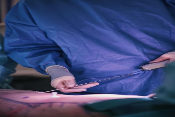 Doctores realizando una cirugía estética a un paciente, para eliminar el exceso de grasa en la zona del abdomen