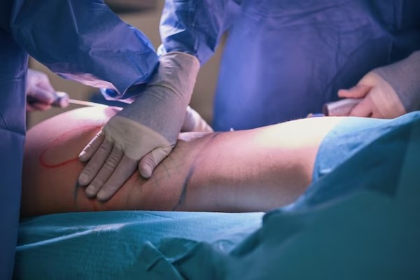 Doctores realizando una cirugía estética a una mujer, para eliminar el exceso de grasa en su cadera y abdomen