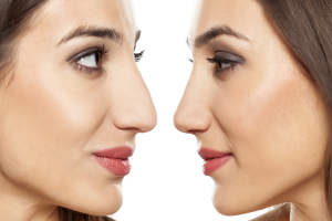 Rinoplastia en Zaragoza