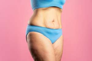 Abdominoplastia en Zaragoza