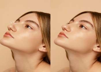 Rinoplastia en Murcia - imagen del antes y después de la rinoplastia de una mujer joven