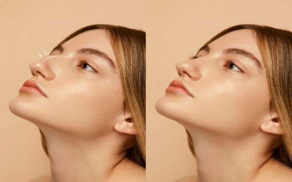 Rinoplastia en Murcia - imagen del antes y después de la rinoplastia de una mujer joven