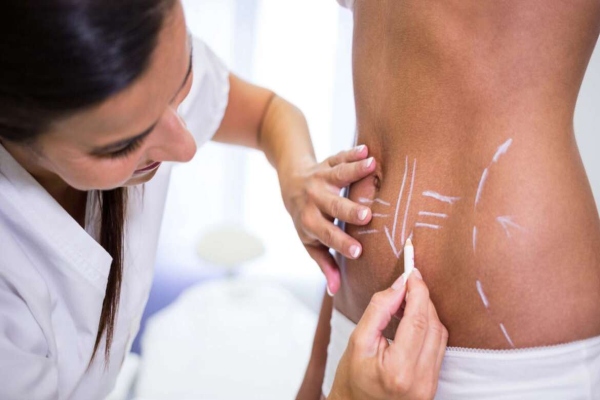 Las mejores clínicas de abdominoplastia en Palma de Mallorca - Cirujano plástico traza líneas guía para llevar a cabo un procedimiento quirúrgico en la pared abdominal de una paciente con grasa localizada