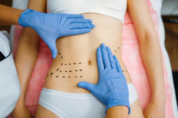Las mejores clínicas de abdominoplastia en Las Palmas - imagen de una paciente en la camilla de la consulta del cirujano plástico mientras realiza un examen y dibuja las líneas de una posible abdominoplastia