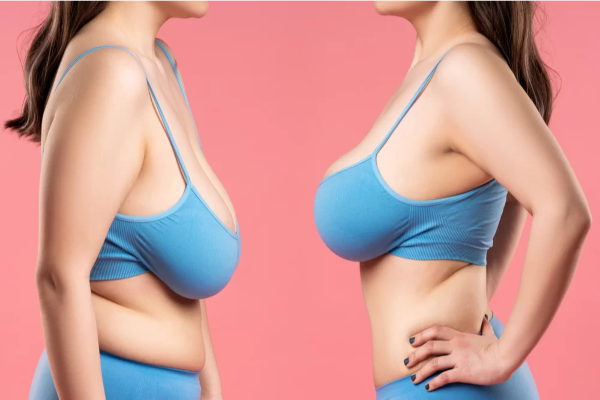 Antes y después de una mastopexia en mujer con alta cantidad de grasa corporal