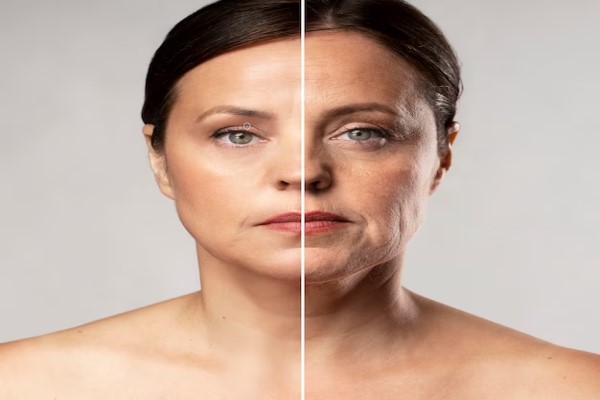 Clínicas de hilos tensores - Imagen comparativa de una mujer luego de realizarse el tratamiento de hilos tensores, lo cual permite reafirmar y rejuvenecer la piel del rostro