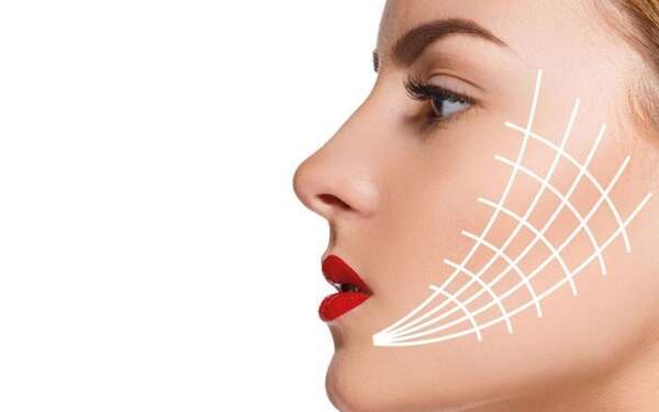 Clínicas de hilos tensores - Imagen referencial del tratamiento remallado de hilos tensores en el rostro de una mujer, lo cual permite rejuvenecer la piel