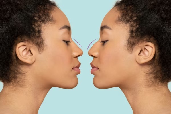 Mejor doctor de rinoplastia en Madrid - Antes y después de una cirugía plástica para mejorar el perfil de la nariz de una joven de tez morena y cabello rizado