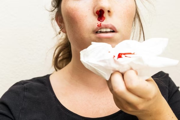 Mejor doctor de rinoplastia en Madrid - Mujer de camisa negra toma un pañuelo para contener el sangrado espontáneo de una de sus fosas nasales