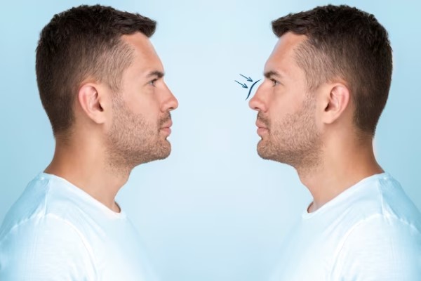 Mejor doctor de rinoplastia en Madrid - Cambios favorables en la nariz de un hombre dan cuenta del antes y el después de un procedimiento quirúrgico