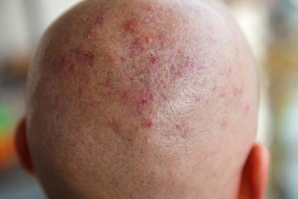 Foliculitis - Cuero cabelludo lleno de granos en paciente masculino con problemas capilares