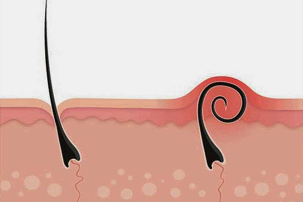 Foliculitis - Ilustración de un vello encarnado y enrojecido debajo de la superficie cutánea