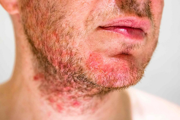 Foliculitis - Hombre con lesiones en el barba por folículos inflamados tras afeitarse con máquina