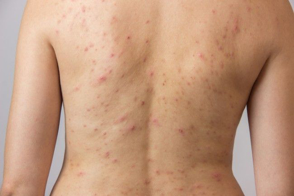 Lesiones cutáneas en la espalda por proceso inflamatorio en persona de tez blanca