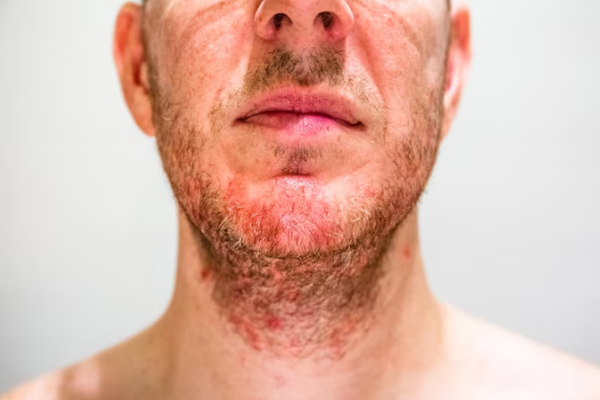 Foliculitis - Hombre con bultos y protuberancias en el rostro por folículos pilosos inflamados