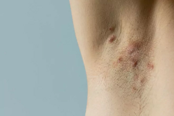 Foliculitis - Axila con vellos visiblemente enrojecidos por proceso inflamatorio tras afeitado