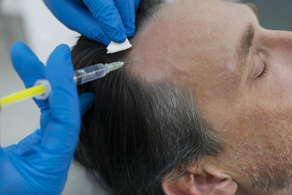 Clínicas de injerto capilar en Cataluña - Doctor realizando un tratamiento de trasplante de cabello a un paciente masculino