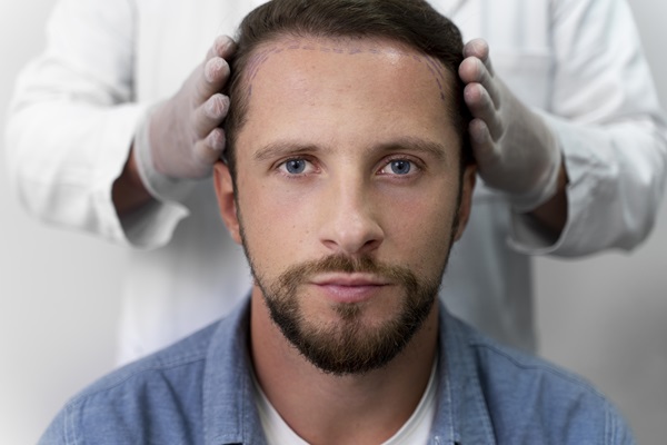 Costras tras el injerto capilar - Doctor revisando la evolución del paciente luego del implante de cabello