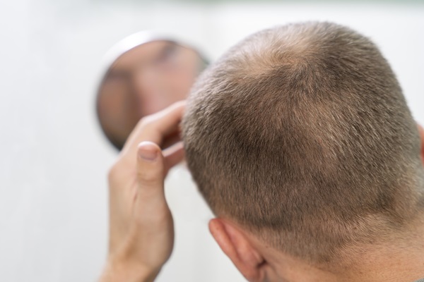 Costras tras el injerto capilar - Hombre observando en el espejo que le están saliendo costras luego del implante de cabello