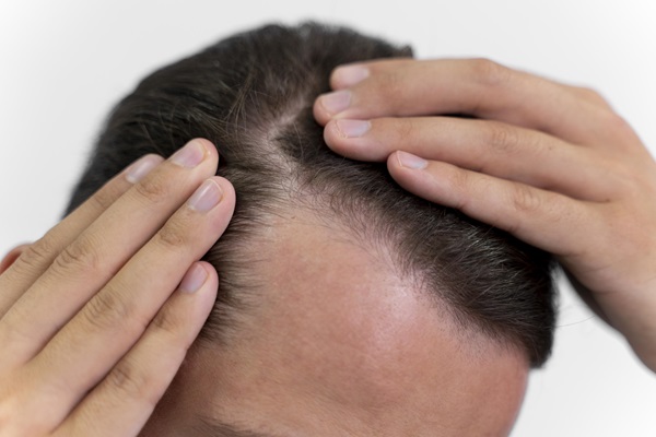 Cuántos pelos tenemos en la cabeza - Hombre con pérdida de cabello en las entradas, a causa de la alopecia androgénica