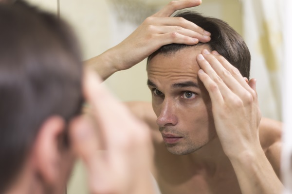 Hombre observando en el espejo que se le están marcando las entradas por la caída del cabello, debido a la alopecia androgénica