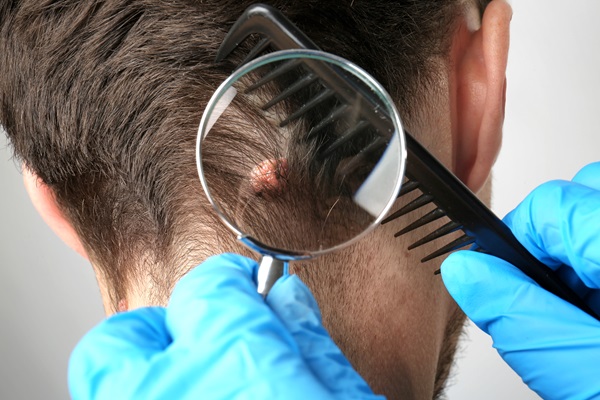 Costras tras el injerto capilar - Doctor examinando la infección que presenta el paciente en el cuero cabelludo, para recetar el tratamiento adecuado