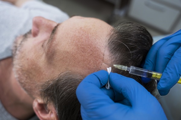 Cirujanos capilares de Palma de Mallorca - Médico especialista realizando un implante capilar a un hombre con alopecia