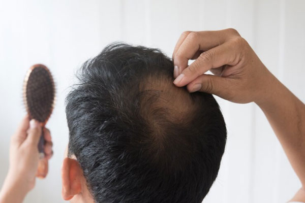 Coronilla despoblada - Hombre con cepillo en mano enfrenta una pérdida de cabello en la parte posterior de su cabeza