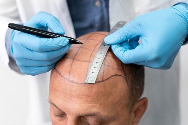 Tricólogo traza líneas guía para llevar a cabo un trasplante de pelo exitoso