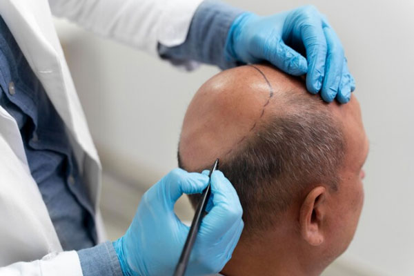 Cirujano trabaja en el diseño de un injerto capilar para mejorar la apariencia de un paciente con alopecia