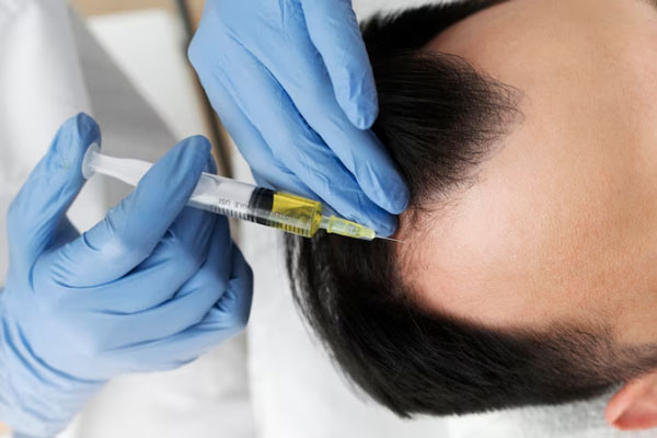 Coronilla despoblada - Hombre con entradas recibe tratamiento de plasma rico en plaquetas en manos de un especialista
