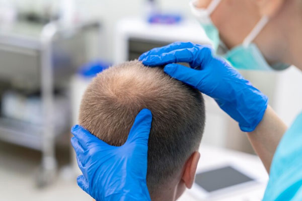 Coronilla despoblada - Dermatóloga examina con detenimiento el cuero cabelludo de un paciente con alopecia
