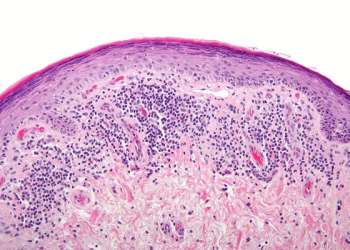 Liquen plano capilar, síntomas, causas y cómo se cura - muestra al microscopio del liquen plano pilar