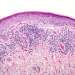Liquen plano capilar, síntomas, causas y cómo se cura - muestra al microscopio del liquen plano pilar