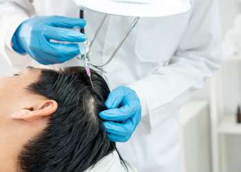 Injerto capilar en Valladolid - Doctor realizando un implante capilar a un paciente masculino, para repoblar las áreas afectadas por la alopecia