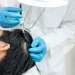 Injerto capilar en Valladolid - Doctor realizando un implante capilar a un paciente masculino, para repoblar las áreas afectadas por la alopecia