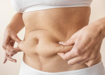Mujer busca tratamientos efectivos para eliminar las cartucheras del abdomen