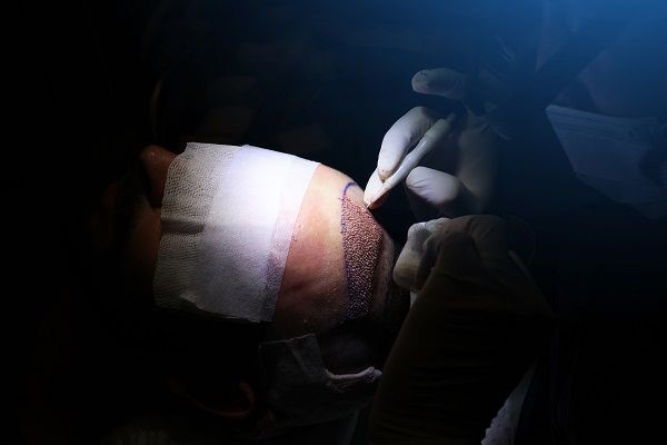 Técnica FUE con implanters - Tricólogo realizando un injerto capilar Madrid con implanters a un paciente con alopecia avanzada