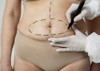 Mejor cirujano plástico en España - Médico cirujano realizando el boceto de la cirugía estética en el abdomen de una mujer