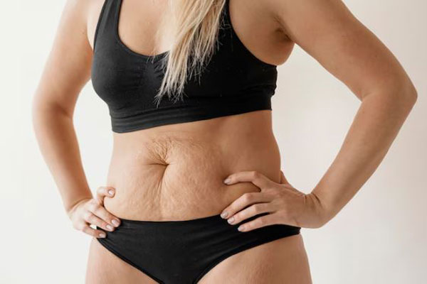 Flacidez abdominal - Mujer con estrías y piel arrugada busca tratamientos estéticos para recuperar la firmeza de su abdomen