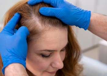 diagnosticar alopecia